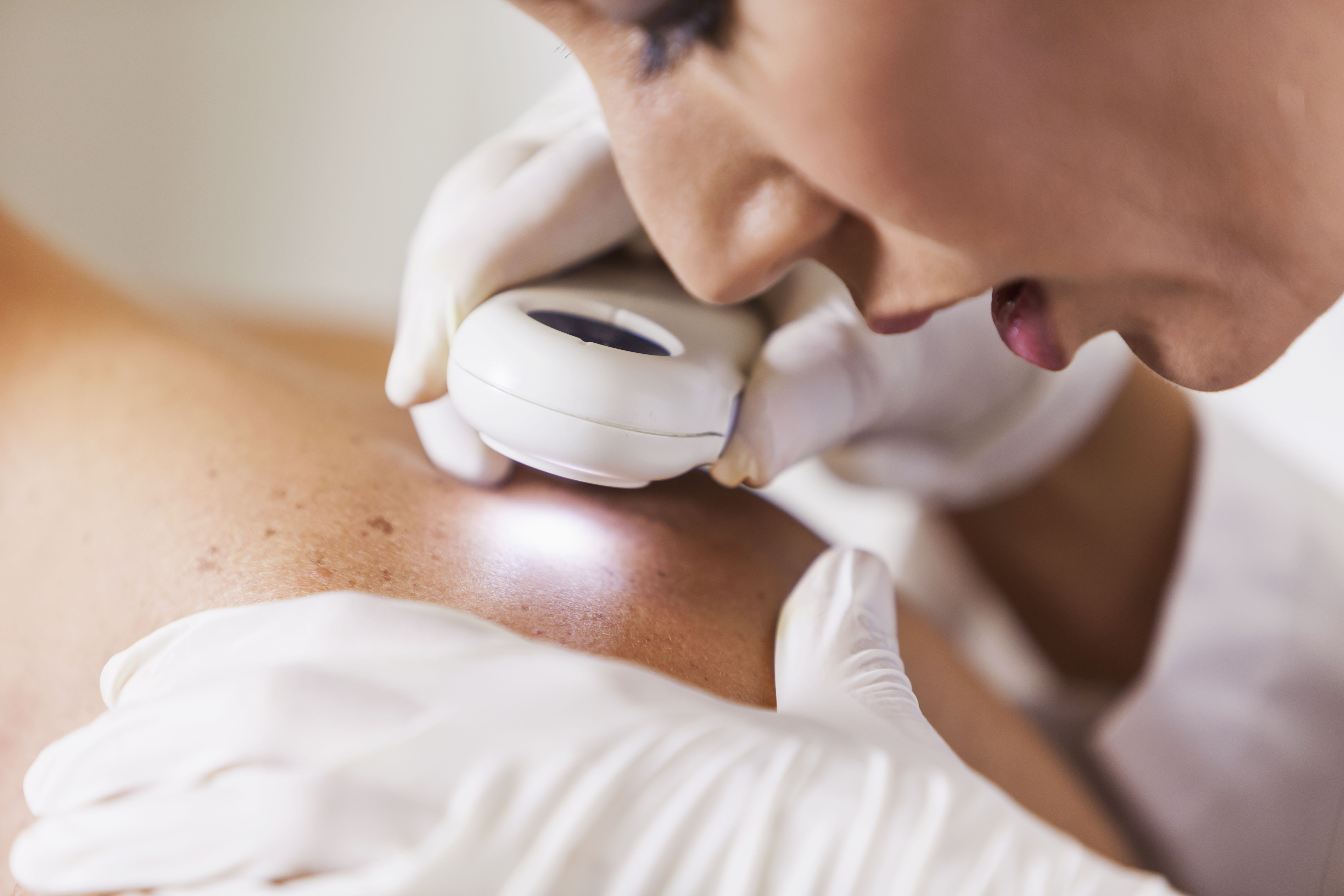 Skin cancer: spotting it early is critical